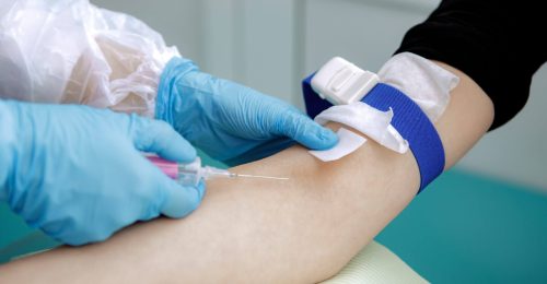 Sedación Intravenosa